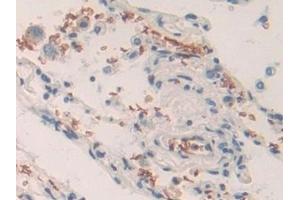 Detection of BND3 in Human Lung cancer Tissue using Polyclonal Antibody to Band 3 (BND3)