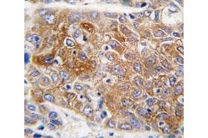 IHC analysis of FFPE human hepatocarcinoma tissue stained with ALDH1L1 antibody (ALDH1L1 anticorps  (AA 717-746))