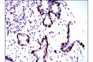 Immunohistochemical analysis of paraffin-embedded prostate tissues using CK5 mouse mAb with DAB staining. (Cytokeratin 5 anticorps  (AA 316-590))