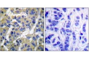 Immunohistochemistry analysis of paraffin-embedded human breast carcinoma, using Keratin 8 (Phospho-Ser73) Antibody. (KRT8 anticorps  (pSer73))