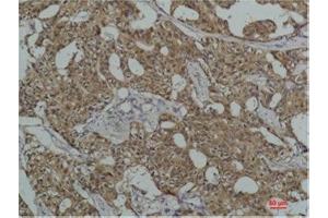 Immunohistochemistry (IHC) analysis of paraffin-embedded Human Breast Carcicnoma using HSC70 Mouse Monoclonal Antibody diluted at 1:200. (Hsc70 anticorps)