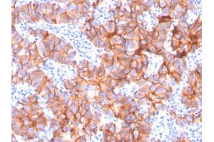 Formalin-fixed, paraffin-embedded human Breast Carcinoma stained with HER-2 Mouse Monoclonal Antibody (ERBB2/3079). (ErbB2/Her2 anticorps  (AA 311-462))