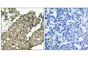 Immunohistochemical analysis of paraffin-embedded human breast carcinoma tissue using G3BP-1 (phospho-Ser232) antibody (E021102). (G3BP1 anticorps  (pSer232))