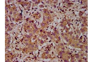 IHC image of ABIN7150047 diluted at 1:400 and staining in paraffin-embedded human liver cancer performed on a Leica BondTM system. (Adam23 anticorps  (AA 498-647))