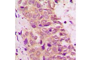 Immunohistochemical analysis of BAD staining in human prostate cancer formalin fixed paraffin embedded tissue section. (BAD anticorps  (C-Term))
