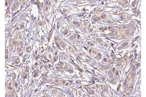 ABIN6267655 at 1/100 staining human Breast carcinoma tissue sections by IHC-P. (MED1 anticorps  (pThr1457))