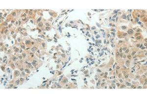 Immunohistochemistry of paraffin-embedded Human lung cancer using NDRG2 Polyclonal Antibody at dilution of 1:50 (NDRG2 anticorps)