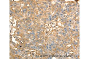 Immunohistochemistry of Human ovarian cancer using PSMD9 Polyclonal Antibody at dilution of 1:40 (PSMD9 anticorps)