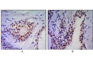 Immunohistochemical analysis of paraffin-embedded human prostata tissues (A, B) using anti-NKX3A antibody with DAB staining. (NKX3-1 anticorps)