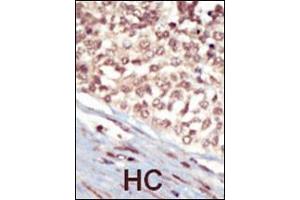Formalin-fixed and paraffin-embedded human cancer tissue reacted with the primary antibody, which was peroxidase-conjugated to the secondary antibody, followed by AEC staining.