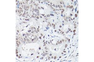 Immunohistochemistry of paraffin-embedded human colon carcinoma using DNA Ligase IV Rabbit pAb (ABIN3022474, ABIN3022475, ABIN3022476 and ABIN6218843) at dilution of 1:100 (40x lens). (LIG4 anticorps  (AA 612-911))