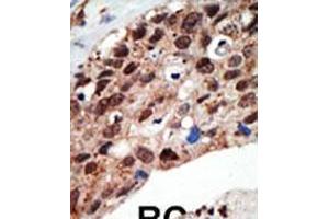 Formalin-fixed and paraffin-embedded human cancer tissue reacted with the primary antibody, which was peroxidase-conjugated to the secondary antibody, followed by DAB staining.
