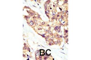 Formalin-fixed and paraffin-embedded human cancer tissue reacted with DOK5 polyclonal antibody  , which was peroxidase-conjugated to the secondary antibody, followed by AEC staining. (DOK5 anticorps  (AA 276-306))