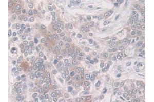 Detection of PAI1 in Human Prostate cancer Tissue using Monoclonal Antibody to Plasminogen Activator Inhibitor 1 (PAI1)