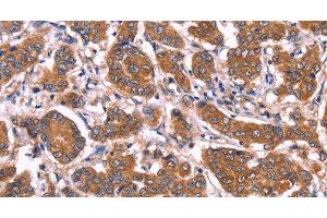 Immunohistochemistry of paraffin-embedded Human breast cancer tissue using COL20A1 Polyclonal Antibody at dilution 1:40 (COL20A1 anticorps)