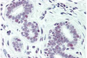 Human Breast (formalin-fixed, paraffin-embedded) stained with PAX2 antibody ABIN337176 at 1:50 followed by biotinylated goat anti-rabbit IgG secondary antibody ABIN481713, alkaline phosphatase-streptavidin and chromogen.
