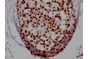 IHC image of ABIN7127498 diluted at 1:100 and staining in paraffin-embedded human breast cancer performed on a Leica BondTM system.