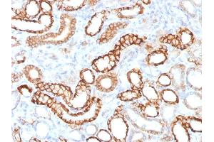Formalin-fixed, paraffin-embedded human Renal Cell Carcinoma stained with KSP-Cadherin Rabbit Recombinant Monoclonal Antibody (CDH16/1532R) (Recombinant Cadherin-16 anticorps)
