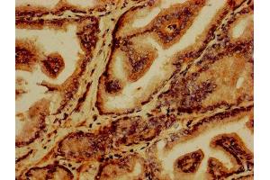 IHC image of ABIN7153521 diluted at 1:1200 and staining in paraffin-embedded human prostate tissue performed on a Leica BondTM system.