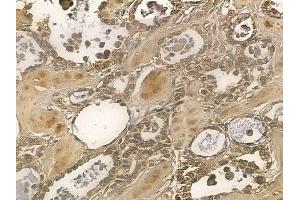 NSMAF Mouse Monoclonal Antibody at 1/100 staining human ovarian cancer by IHC-P. (NSMAF anticorps)