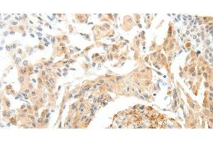 Immunohistochemistry of paraffin-embedded Human cervical cancer tissue using SEMA3D Polyclonal Antibody at dilution 1:50 (SEMA3D anticorps)