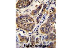 YOD1 Antibody (C-term) immunohistochemistry analysis in formalin fixed and paraffin embedded human bladder carcinoma followed by peroxidase conjugation of the secondary antibody and DAB staining.