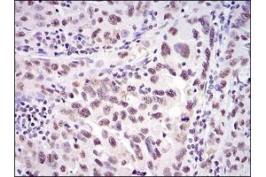 Immunohistochemical analysis of paraffin-embedded endometrial cancer tissues using XRCC6 mouse mAb with DAB staining. (XRCC6 anticorps  (AA 6-214))