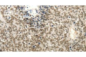Immunohistochemistry of paraffin-embedded Human ovarian cancer tissue using Frizzled 10 Polyclonal Antibody at dilution 1:50 (FZD10 anticorps)