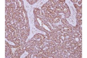 IHC-P Image Immunohistochemical analysis of paraffin-embedded human breast cancer, using HXK I, antibody at 1:250 dilution. (Hexokinase 1 anticorps)