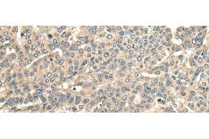 Immunohistochemistry of paraffin-embedded Human liver cancer tissue using CCDC113 Polyclonal Antibody at dilution of 1:65(x200) (CCDC113 anticorps)