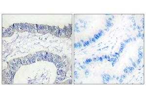 Immunohistochemistry analysis of paraffin-embedded human lung carcinoma tissue, using FA12 (heavy chain, Cleaved-Ile20) antibody.