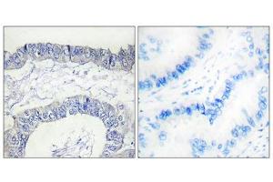 Immunohistochemistry analysis of paraffin-embedded human lung carcinoma tissue, using FA12 (heavy chain, Cleaved-Ile20) antibody. (F12 anticorps  (Cleaved-Ile20, Heavy Chain, N-Term))