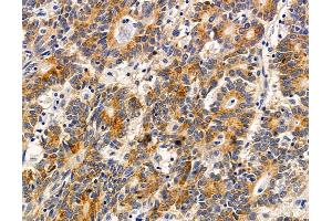 ABIN7095898 and ABIN7099960 at 1/100 staining human colorectal cancer and adjacent non-tumor tissue by IHC-P. (TRIML2 anticorps)