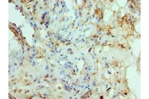 Immunohistochemistry of paraffin-embedded human prostate cancer using ABIN7150291 at dilution of 1:100 (RAD51D anticorps  (AA 1-328))