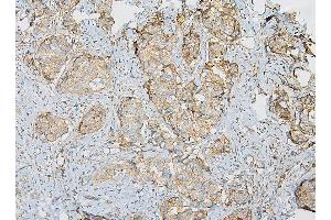 IHC analysis of IQGAP1 using anti-IQGAP1 antibody (ABIN6719262). (IQGAP1 anticorps)