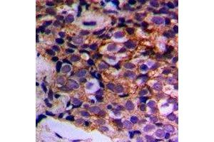 Immunohistochemical analysis of MTIF3 staining in human prostate cancer formalin fixed paraffin embedded tissue section. (MTIF3 anticorps)