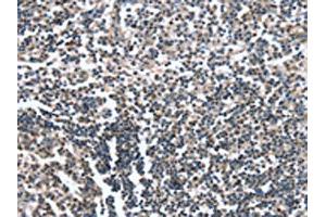 The image on the left is immunohistochemistry of paraffin-embedded Human tonsil tissue using ABIN7190052(CAMTA1 Antibody) at dilution 1/15, on the right is treated with synthetic peptide. (CAMTA1 anticorps)