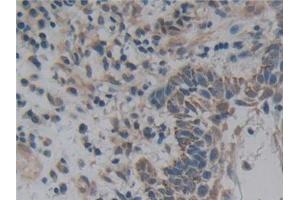 Detection of NFkB in Human Skin cancer Tissue using Polyclonal Antibody to Nuclear Factor Kappa B (NFkB)