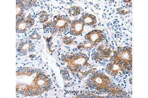 Immunohistochemistry of Human stomach cancer using CLDN7 Polyclonal Antibody at dilution of 1:50 (Claudin 7 anticorps)