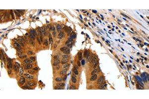 Immunohistochemistry of paraffin-embedded Human colon cancer using 14-3-3 beta/alpha Polyclonal Antibody at dilution of 1:30 (YWHAB anticorps)
