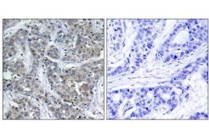 Immunohistochemical analysis of paraffin-embedded human breast carcinoma tissue, using Stathmin 1 (Ab-15) antibody (E021227). (Stathmin 1 anticorps)