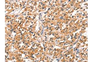 The image on the left is immunohistochemistry of paraffin-embedded Human thyroid cancer tissue using ABIN7192186(RHOBTB2 Antibody) at dilution 1/30, on the right is treated with synthetic peptide. (RHOBTB2 anticorps)