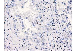 Immunohistochemical staining of paraffin-embedded Adenocarcinoma of Human ovary tissue using anti-C1orf50 mouse monoclonal antibody. (C1ORF50 anticorps)