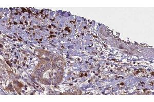 ABIN6276494 at 1/100 staining Human liver cancer tissue by IHC-P.