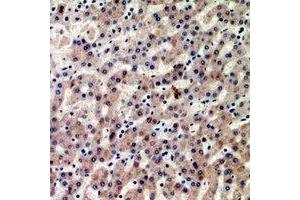 Immunohistochemical analysis of CIDEB staining in human liver cancer formalin fixed paraffin embedded tissue section. (CIDEB anticorps)