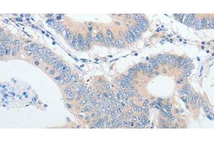 Immunohistochemistry of paraffin-embedded Human colon cancer using IGFBP1 Polyclonal Antibody at dilution of 1:30 (IGFBPI anticorps)