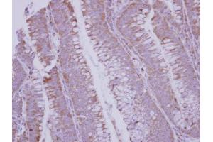 IHC-P Image Immunohistochemical analysis of paraffin-embedded human colon carcinoma, using BMP10, antibody at 1:250 dilution. (BMP10 anticorps  (C-Term))