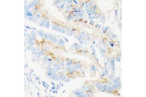 Immunohistochemistry of paraffin-embedded Human colon carcinoma using M Rabbit pAb (ABIN7268390) at dilution of 1:100 (40x lens).
