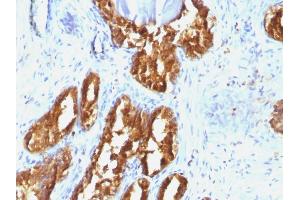 Formalin-fixed, paraffin-embedded human Prostate Carcinoma stained with PSAP Mouse Monoclonal Antibody (ACPP/1338). (ACPP anticorps)