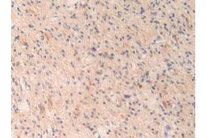 IHC-P analysis of Human Glioma Tissue, with DAB staining. (OIT3 anticorps  (AA 297-506))